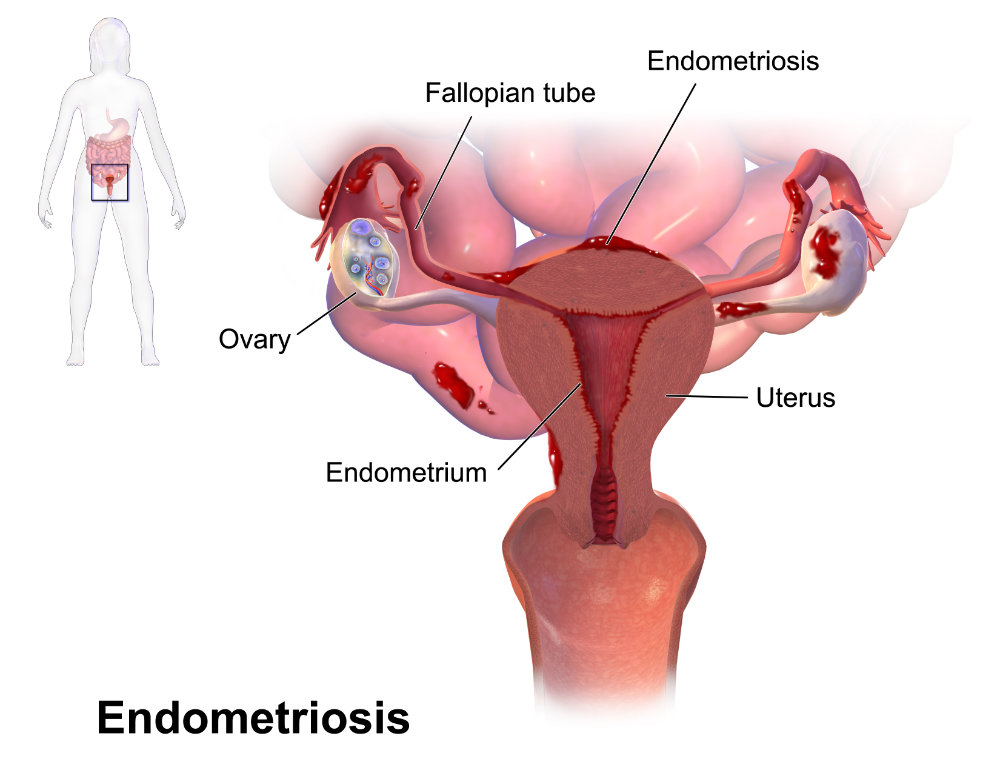 endometriosis que es