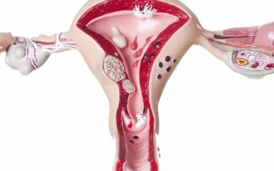 ¿Es tan grave el síndrome de ovario poliquístico?