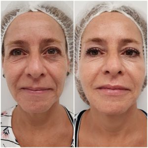 full face antes y despues 1536x1536