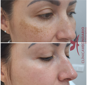 Resultado de Eliminacion de manchas con laser Picosure