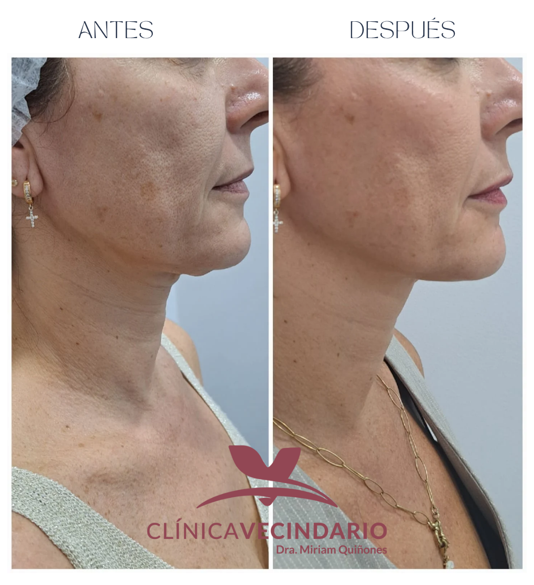 lifting facial sin cirugía antes y después lifting facial sin cirugía fotos de antes y después