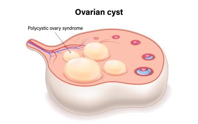 ¿Es posible quedar embarazada con el Síndrome de Ovario Poliquístico (SOP)?