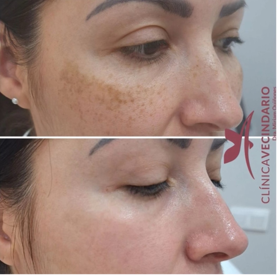resultado antes y después tratamiento melasma