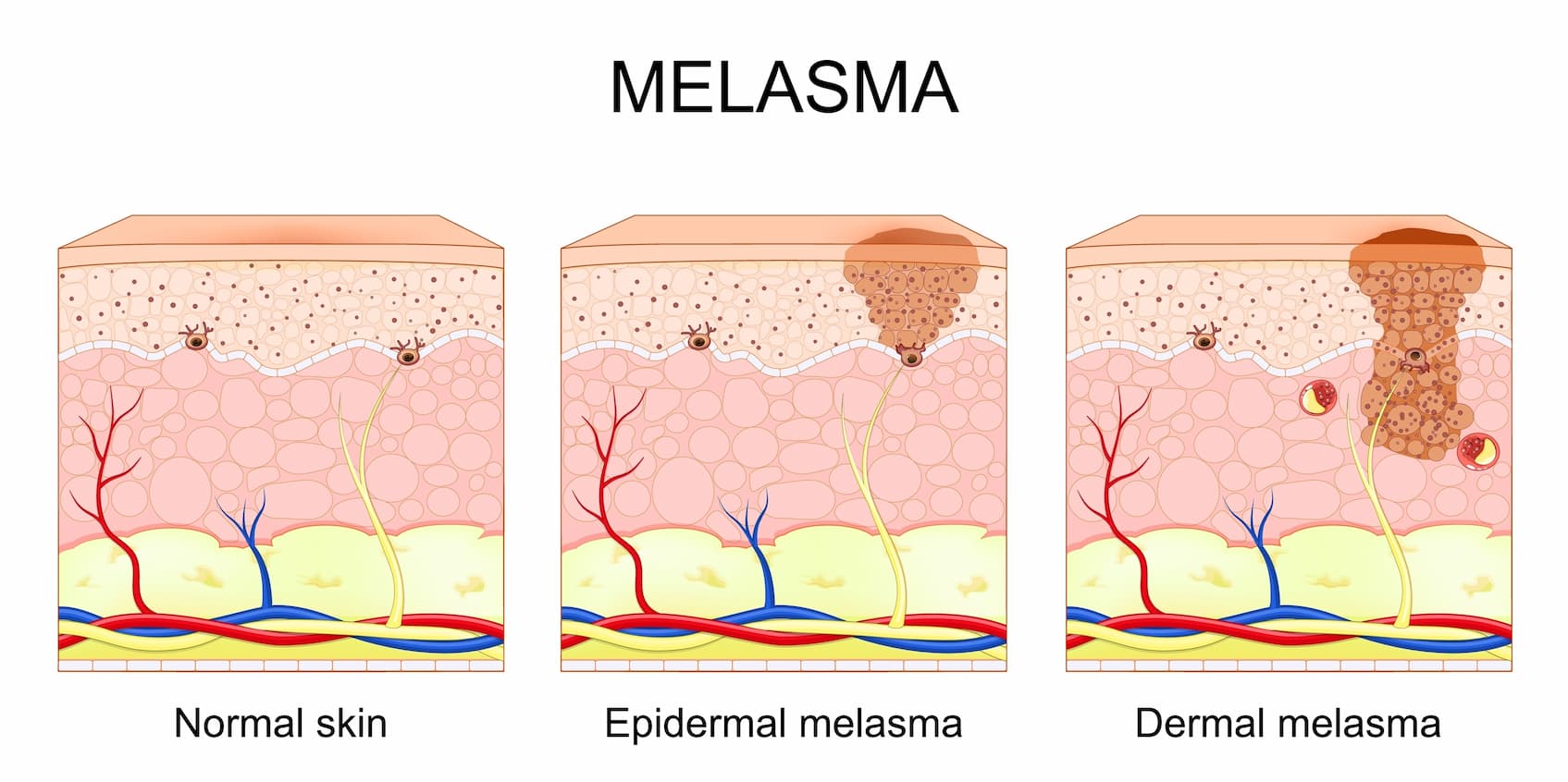 infografia de melasma