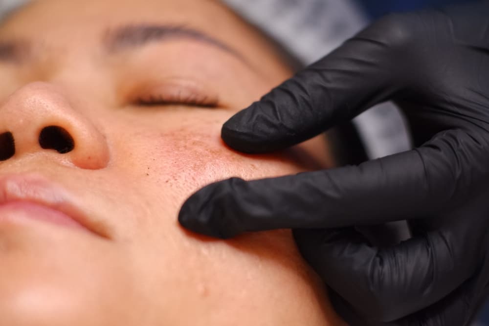 mujer con melasma en la cara