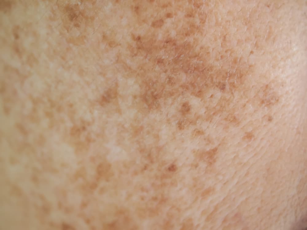 piel con melasma