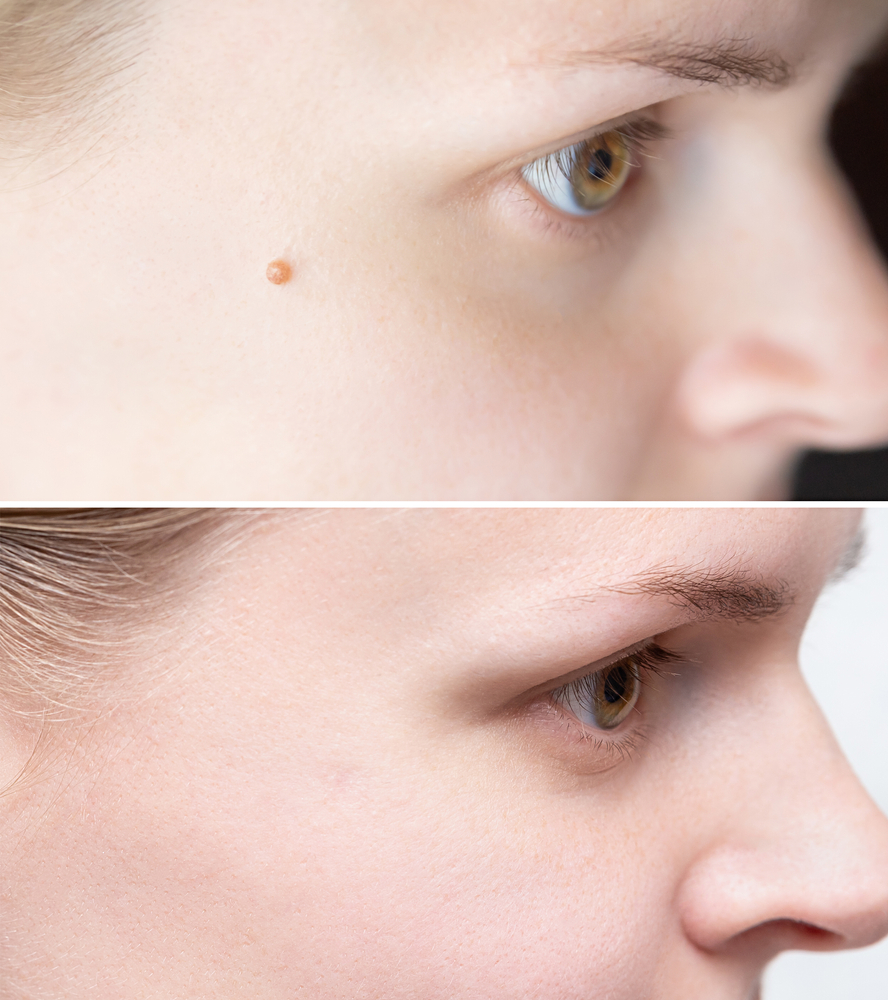 Laser,Or,Electro,Coagulation,Treatment,For,Mole,Removal,Before,And verruga quitada antes y después
