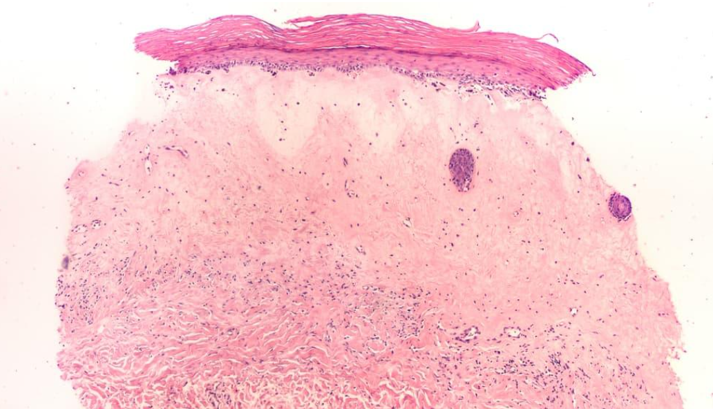 ¿Cuáles son los síntomas del liquen escleroso vulvar?
